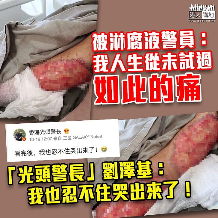 【譴責暴力】被淋腐液警員：我人生從來未試過如此的痛