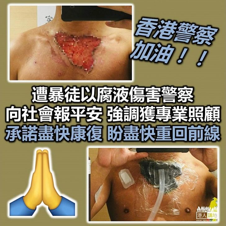 【腐液射警】被腐液傷害警員向大家報平安 強調正接受專業治療 傷處康復理想