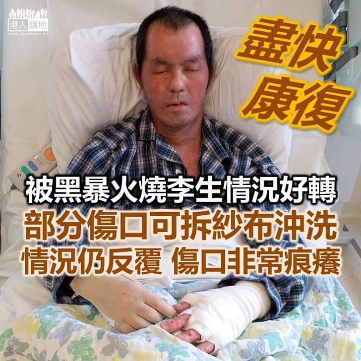 【黑暴可恥】被黑暴分子焚燒李生情況好轉卻仍反覆、正排期做第四次植皮手術