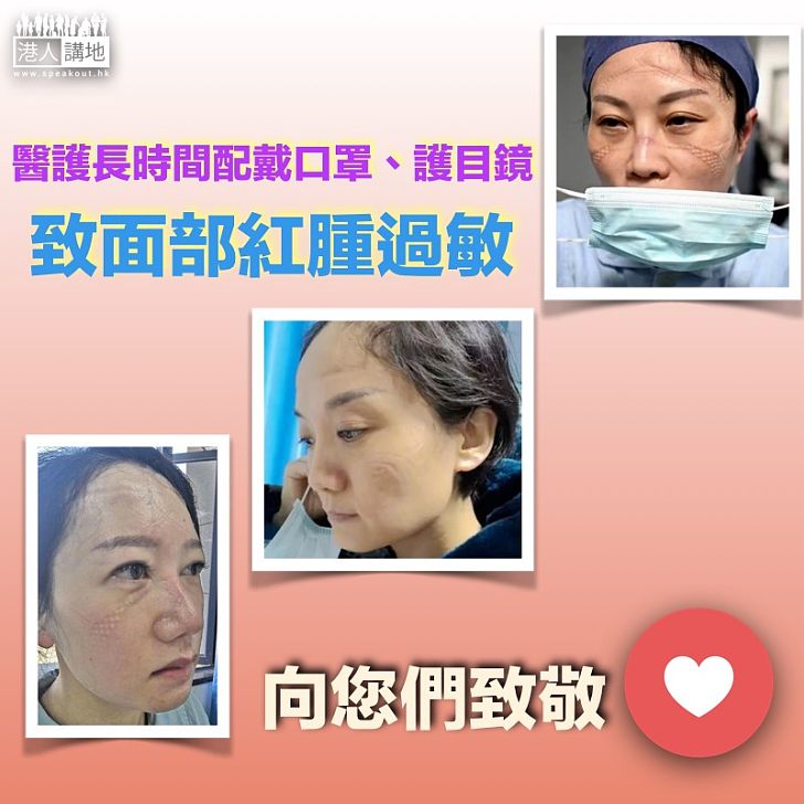 【致敬醫護】醫護人員長時間配戴口罩、護目鏡導致面部紅腫過敏