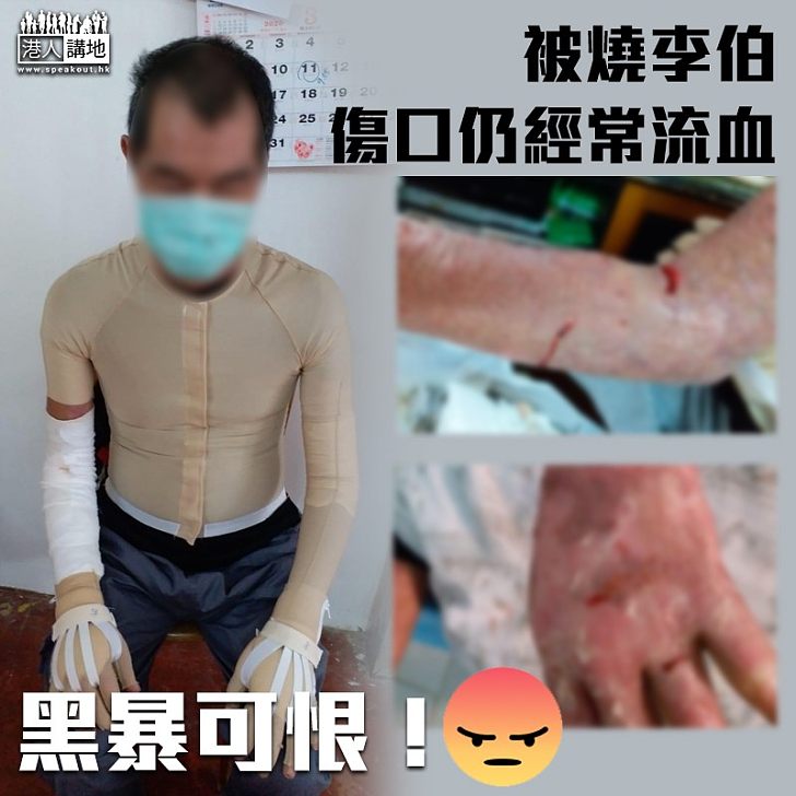 【喪心病狂】被燒李伯傷口仍經常流血：全身傷口都痕到甩骨