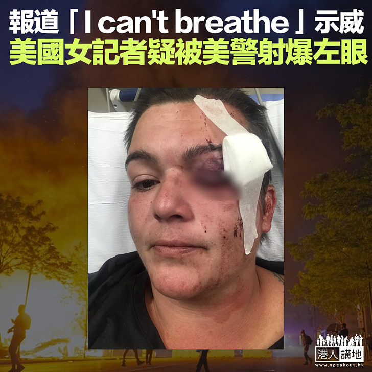 【美國示威】報道「I can't breathe」示威 女記者疑遭警胡椒球彈射眼