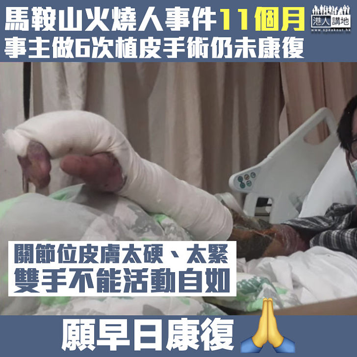 【黑暴運動】馬鞍山火燒人事件11個月 事主李生做6次植皮手術仍未康復