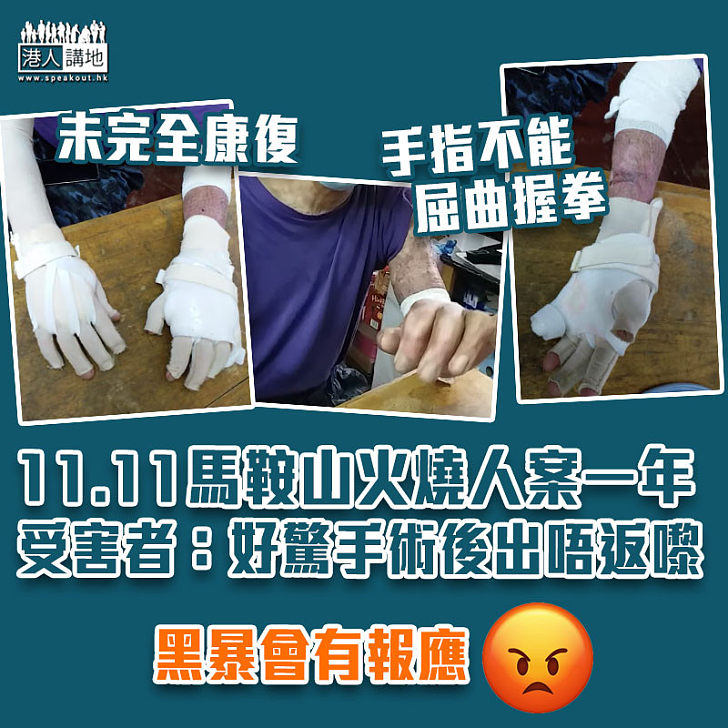 【未敢忘記】11.11馬鞍山火燒人案一年 受害者：好驚做手術之後出唔返嚟