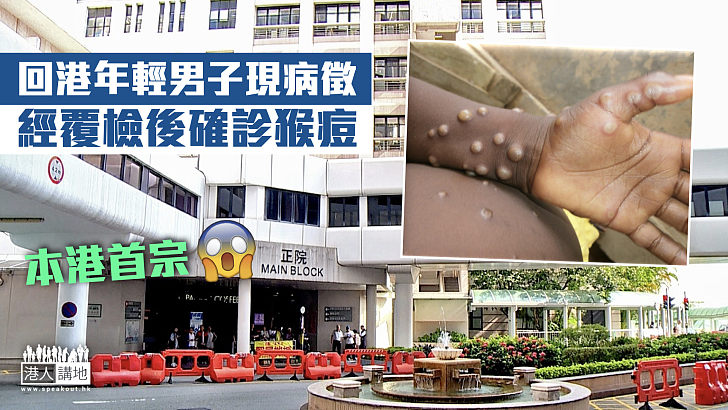 【猴痘病毒】本港現首宗猴痘傳入個案 回港年輕男子現病徵確診